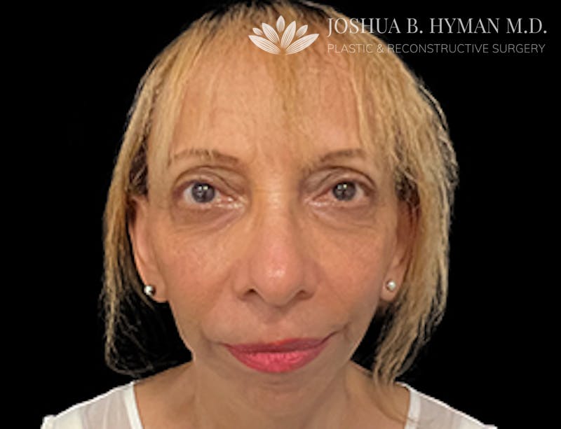 Facelift Before & After Gallery - Patient 77369273 - Image 2