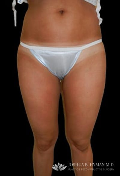 Liposuction Before & After Gallery - Patient 77369667 - Image 1