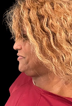 Liposuction Before & After Gallery - Patient 77369668 - Image 1