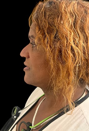 Liposuction Before & After Gallery - Patient 77369668 - Image 2