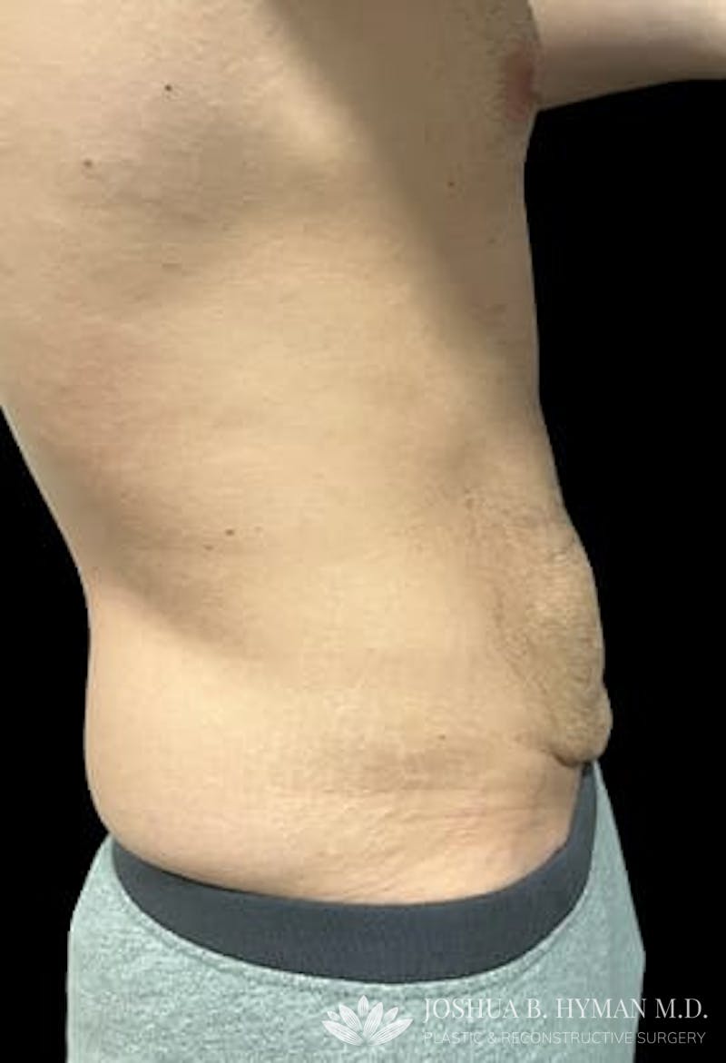 Abdominoplasty Before & After Gallery - Patient 77369673 - Image 3