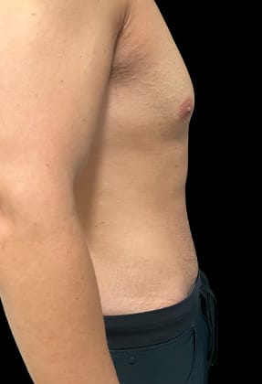 Male Abdominoplasty Before & After Gallery - Patient 77369673 - Image 4