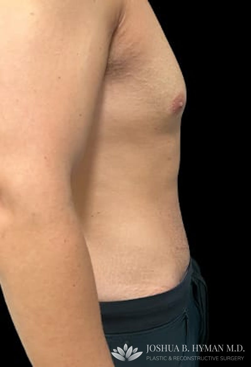 Abdominoplasty Before & After Gallery - Patient 77369673 - Image 4