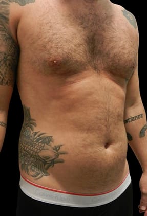 Male Liposuction Before & After Gallery - Patient 77370787 - Image 1