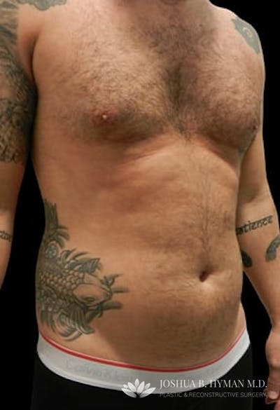 Male Liposuction Before & After Gallery - Patient 77370787 - Image 1