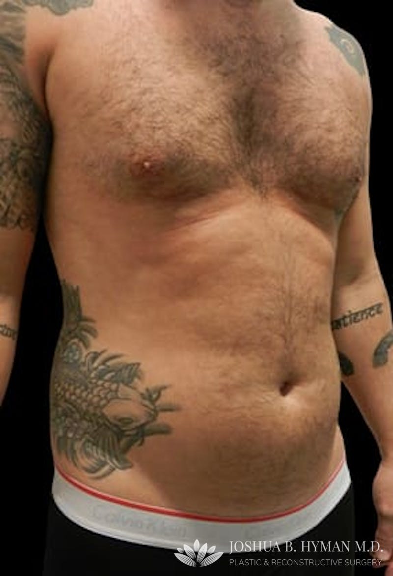 Male Liposuction Before & After Gallery - Patient 77370787 - Image 1