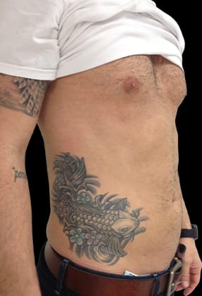 Male Liposuction Before & After Gallery - Patient 77370787 - Image 2