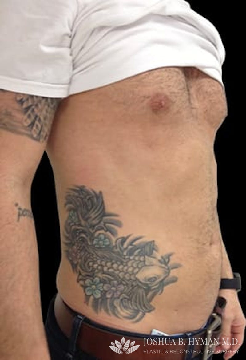 Male Liposuction Before & After Gallery - Patient 77370787 - Image 2