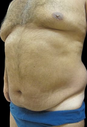 Male Liposuction Before & After Gallery - Patient 77370788 - Image 1