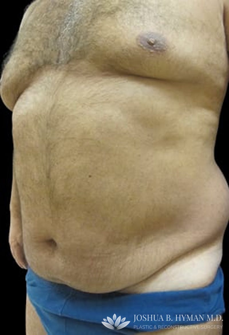 Male Liposuction Before & After Gallery - Patient 77370788 - Image 1