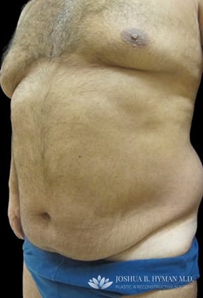 Liposuction Before & After Gallery - Patient 77370788 - Image 1
