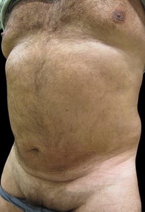 Male Liposuction Before & After Gallery - Patient 77370788 - Image 2
