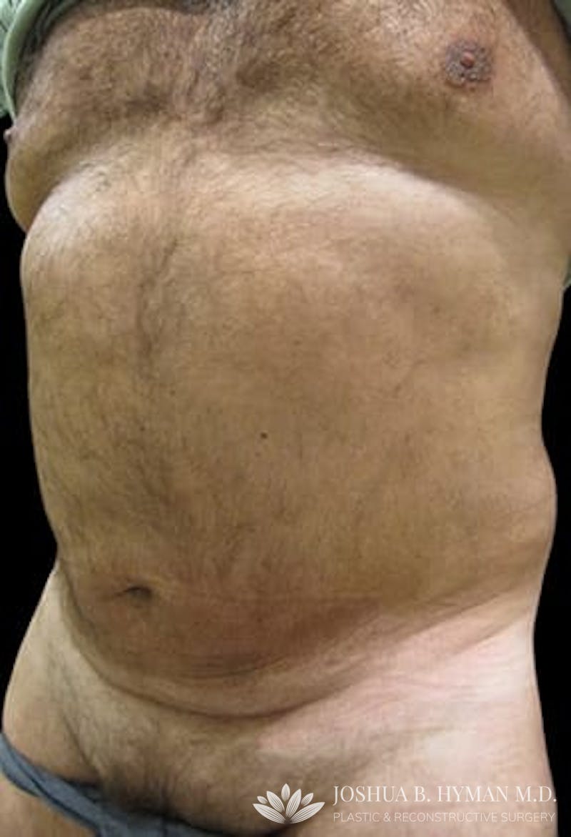 Male Liposuction Before & After Gallery - Patient 77370788 - Image 2