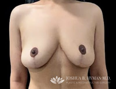 Breast Lift Before & After Gallery - Patient 77371925 - Image 2