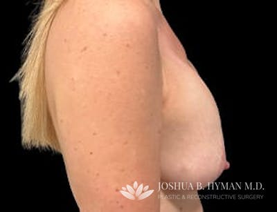 Breast Implant Revision Before & After Gallery - Patient 77371955 - Image 1
