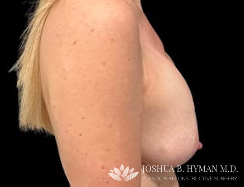 Breast Lift Before & After Gallery - Patient 77371928 - Image 1