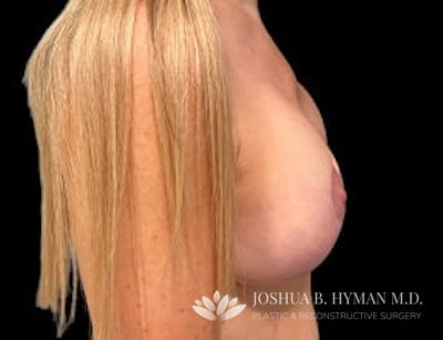 Breast Implant Revision Before & After Gallery - Patient 77371955 - Image 2
