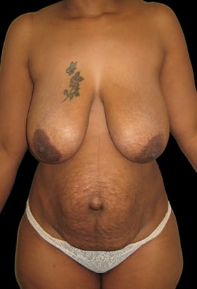 Mommy Makeover Before & After Gallery - Patient 77371934 - Image 1