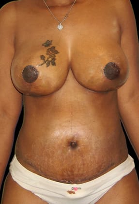 Mommy Makeover Before & After Gallery - Patient 77371934 - Image 2