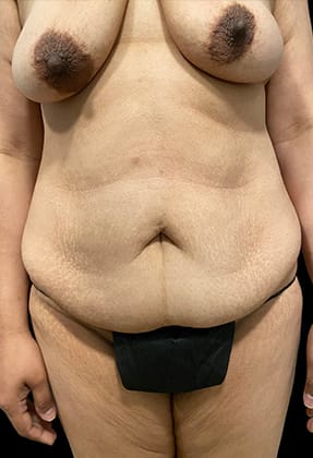 Mommy Makeover Before & After Gallery - Patient 77371936 - Image 1