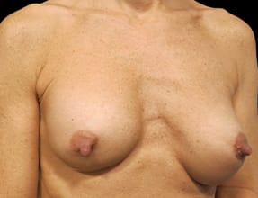 Breast Implant Revision Before & After Gallery - Patient 77371952 - Image 3