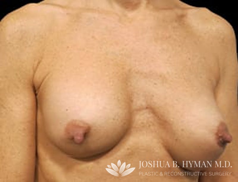 Breast Implant Revision Before & After Gallery - Patient 77371952 - Image 3
