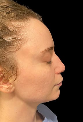 Rhinoplasty Before & After Gallery - Patient 77371968 - Image 1