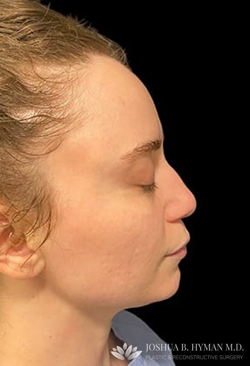 Rhinoplasty Before & After Gallery - Patient 77371968 - Image 1