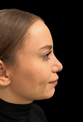 Rhinoplasty Before & After Gallery - Patient 77371968 - Image 2