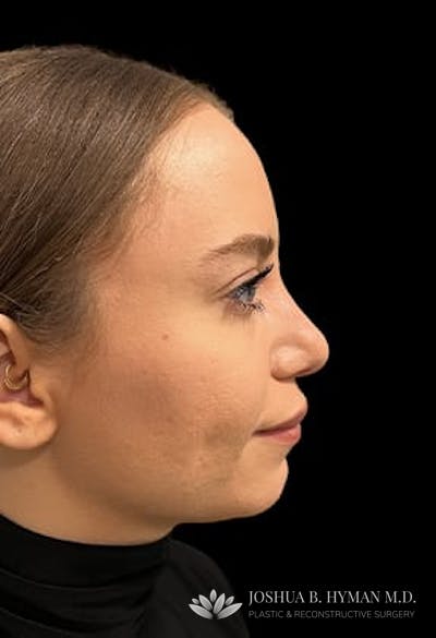 Rhinoplasty Before & After Gallery - Patient 77371968 - Image 2