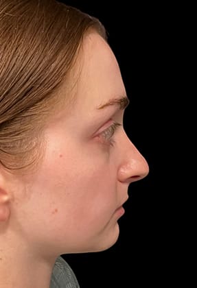 Rhinoplasty Before & After Gallery - Patient 77371967 - Image 1