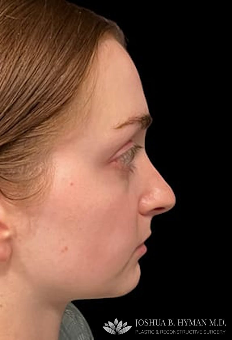 Rhinoplasty Before & After Gallery - Patient 77371967 - Image 1
