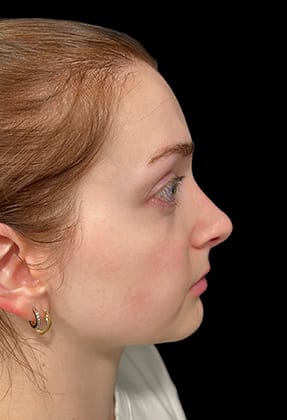 Rhinoplasty Before & After Gallery - Patient 77371967 - Image 2