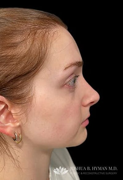 Rhinoplasty Before & After Gallery - Patient 77371967 - Image 2
