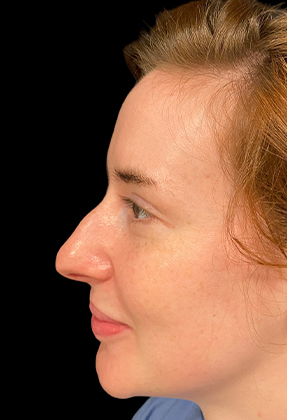 Rhinoplasty Before & After Gallery - Patient 77371966 - Image 1
