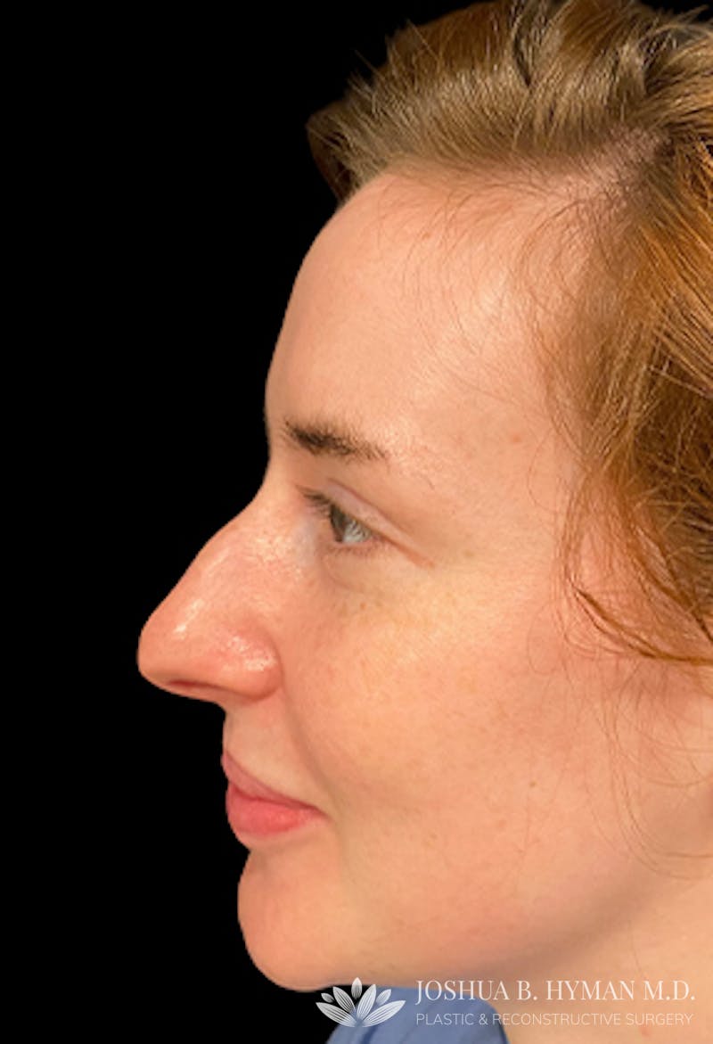 Rhinoplasty Before & After Gallery - Patient 77371966 - Image 1