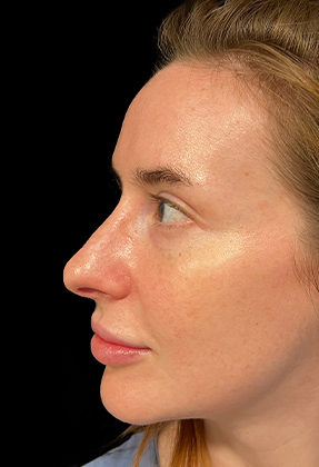 Rhinoplasty Before & After Gallery - Patient 77371966 - Image 2