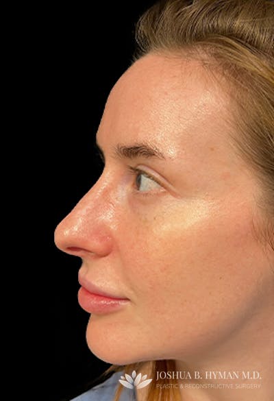 Rhinoplasty Before & After Gallery - Patient 77371966 - Image 2