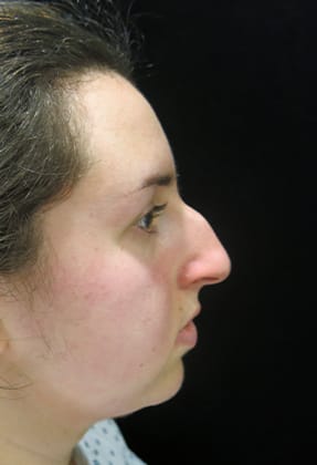 Rhinoplasty Before & After Gallery - Patient 77371965 - Image 1