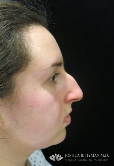 Rhinoplasty Before & After Gallery - Patient 77371965 - Image 1