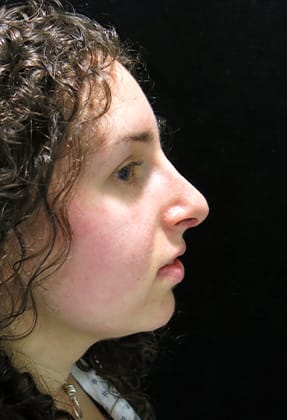 Rhinoplasty Before & After Gallery - Patient 77371965 - Image 2