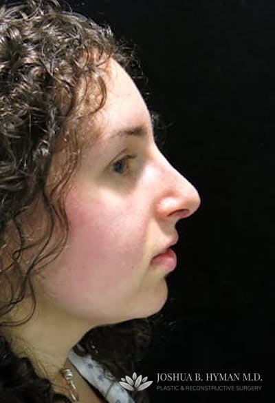 Rhinoplasty Before & After Gallery - Patient 77371965 - Image 2