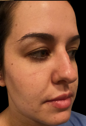 Rhinoplasty Before & After Gallery - Patient 58232312 - Image 1