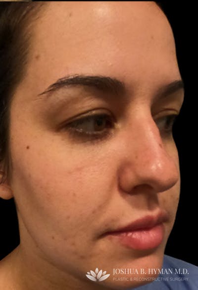 Rhinoplasty Before & After Gallery - Patient 58232312 - Image 1
