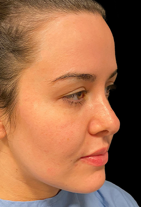 Rhinoplasty Before & After Gallery - Patient 58232312 - Image 2