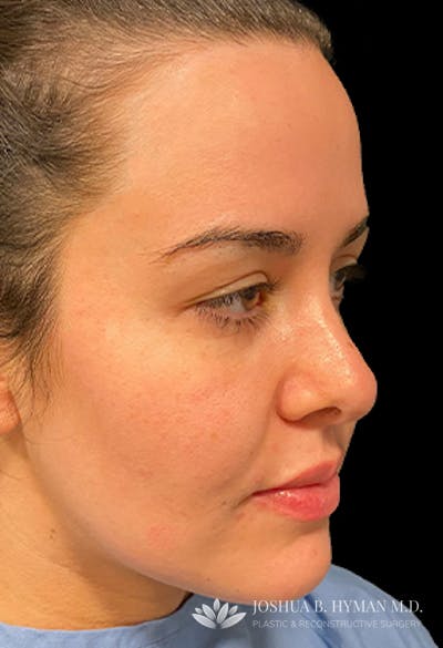 Rhinoplasty Before & After Gallery - Patient 58232312 - Image 2