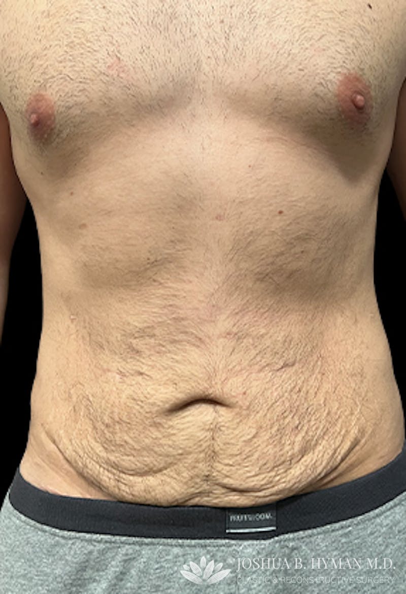 Abdominoplasty Before & After Gallery - Patient 77368593 - Image 1