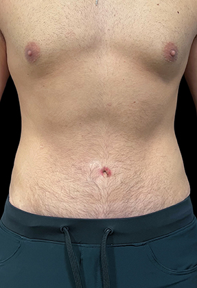 Male Abdominoplasty Before & After Gallery - Patient 77369673 - Image 2