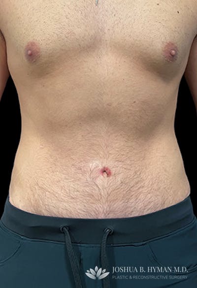 Abdominoplasty Before & After Gallery - Patient 77368593 - Image 2