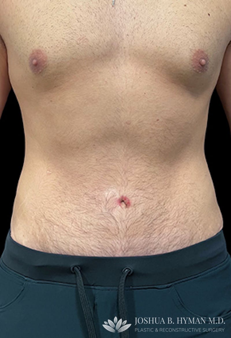 Male Abdominoplasty Before & After Gallery - Patient 77369673 - Image 2